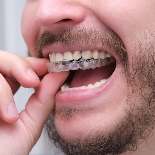 Close-up of a man placing a clear orthodontic aligner over his lower teeth.