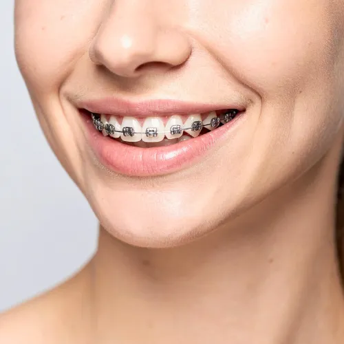 Girl's smile with braces.