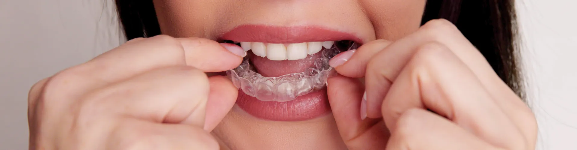 Woman placing clear aligner onto upper teeth.