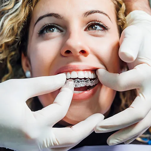 Gloved hands placing clear aligner in woman's mouth.