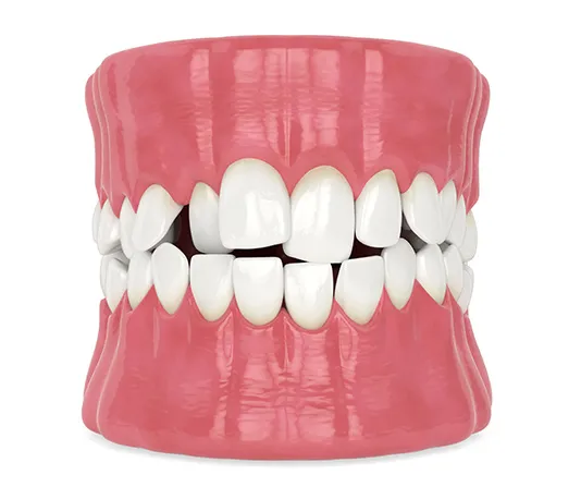 3D model of crowded teeth