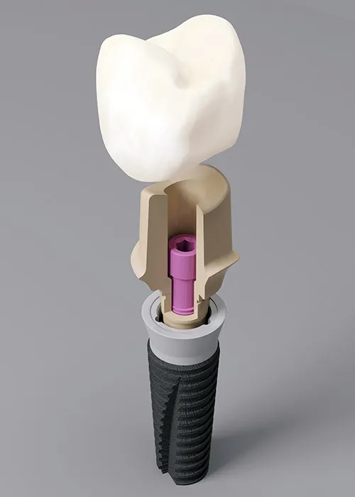 3D render on dental implant