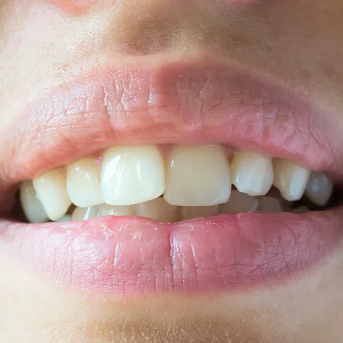 Woman's smile with crooked teeth.