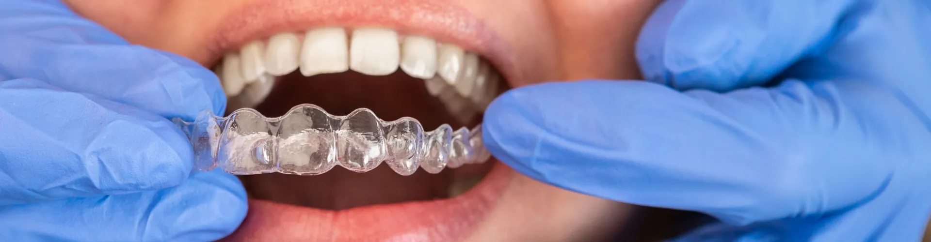Close-up of clear Invisalign aligners being held in front of a patient's teeth by gloved hands.