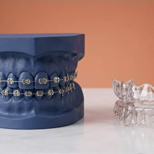 Dental model showing metal braces compared to clear plastic Invisalign aligners for teeth straightening.