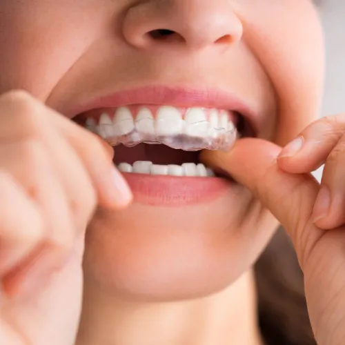 Woman putting clear aligner on her upper teeth.