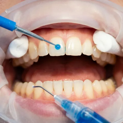 Gloved hands applying bonding material to teeth.