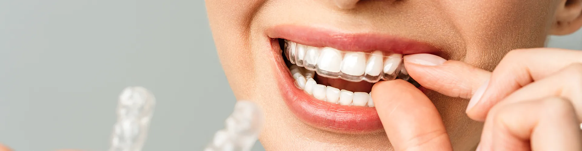 Woman placing clear aligner in her mouth.