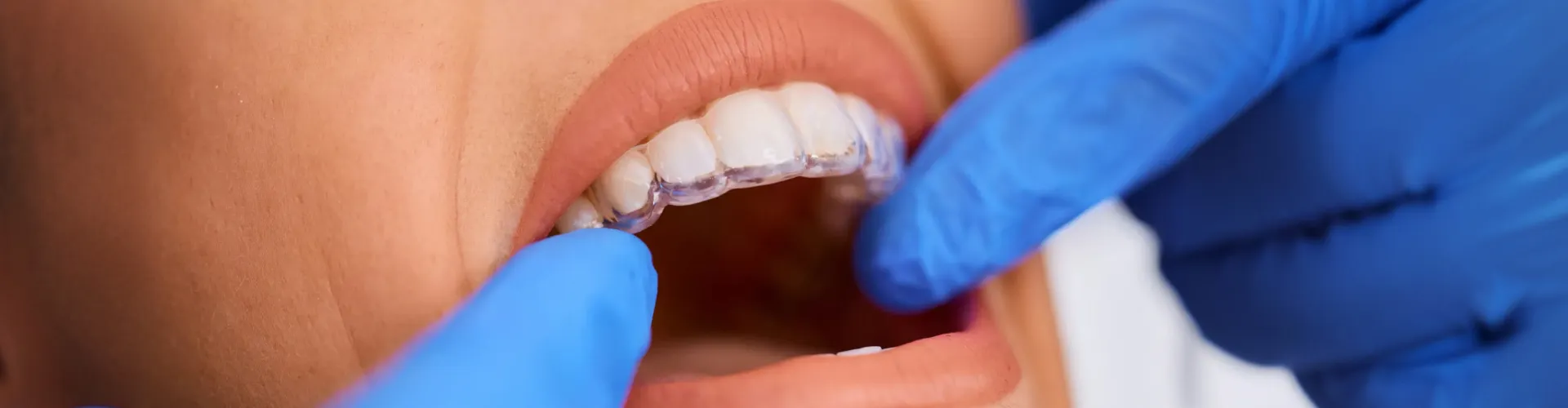Close-up of a patient wearing a clear orthodontic aligner while a dental professional checks the fit with gloved hands.