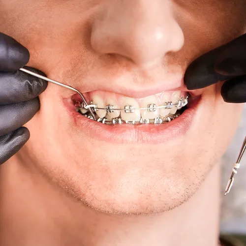 Gloved hands using dental tools on smile of boy with braces.