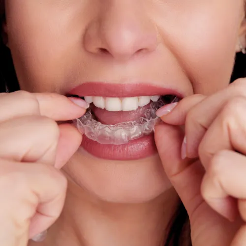 Woman placing clear aligner onto upper teeth.
