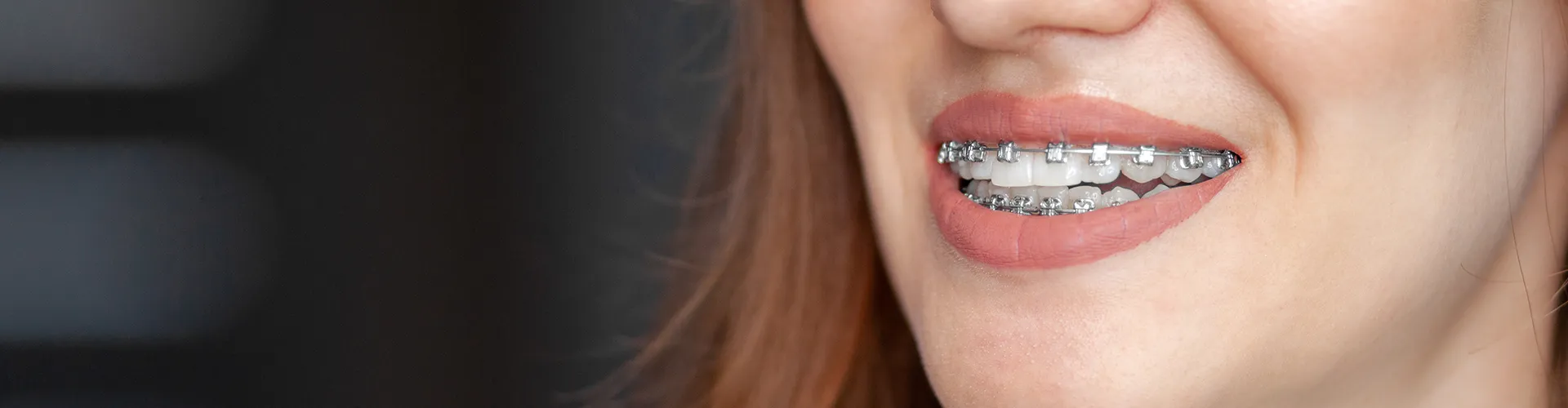 Woman's smile with braces.