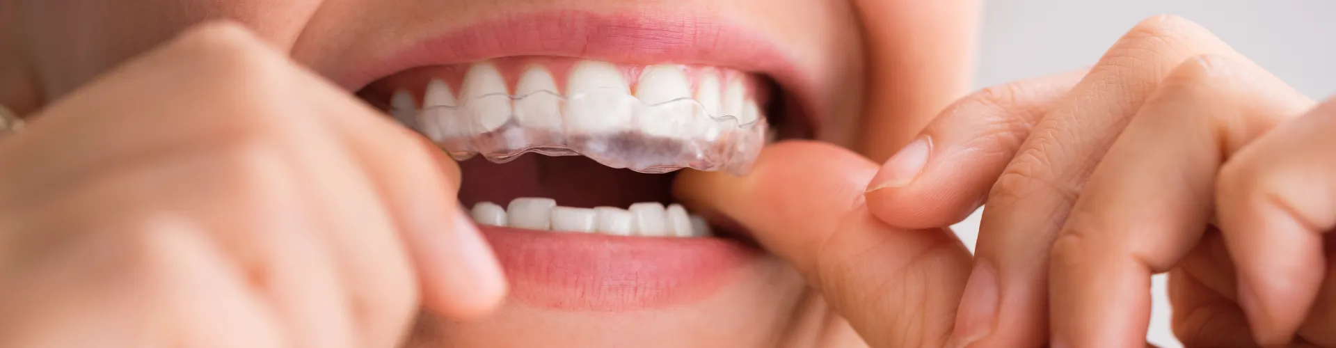 Woman putting clear aligner on her upper teeth.