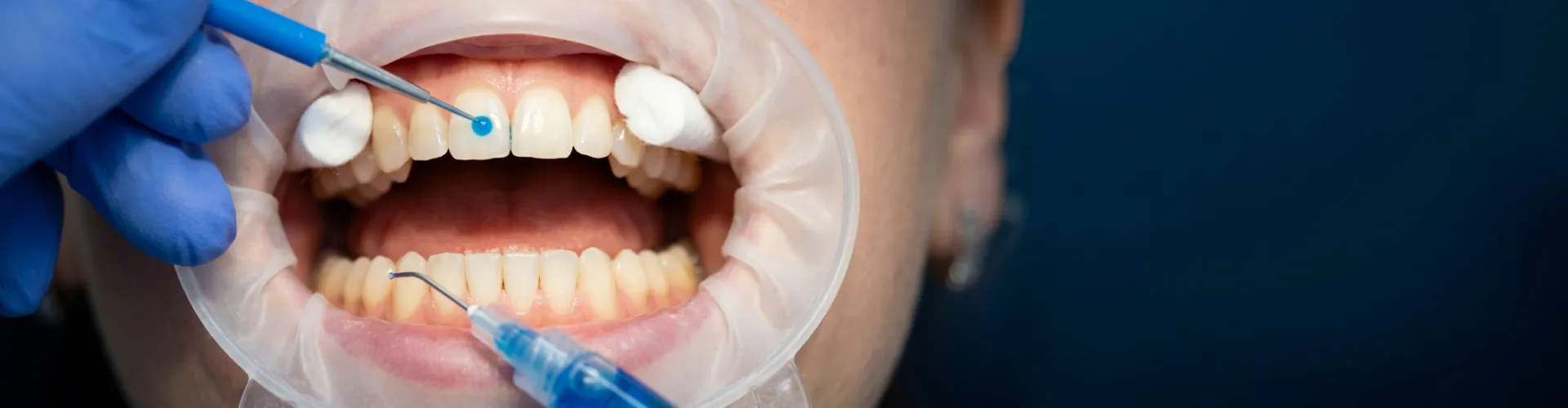 Gloved hands applying bonding material to teeth.