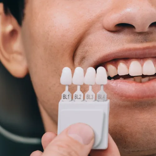 Hand holding tooth shade-matching tool against man's smile.