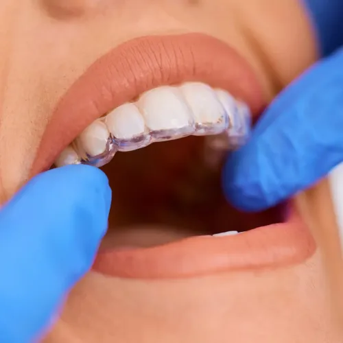 Close-up of a patient wearing a clear orthodontic aligner while a dental professional checks the fit with gloved hands.