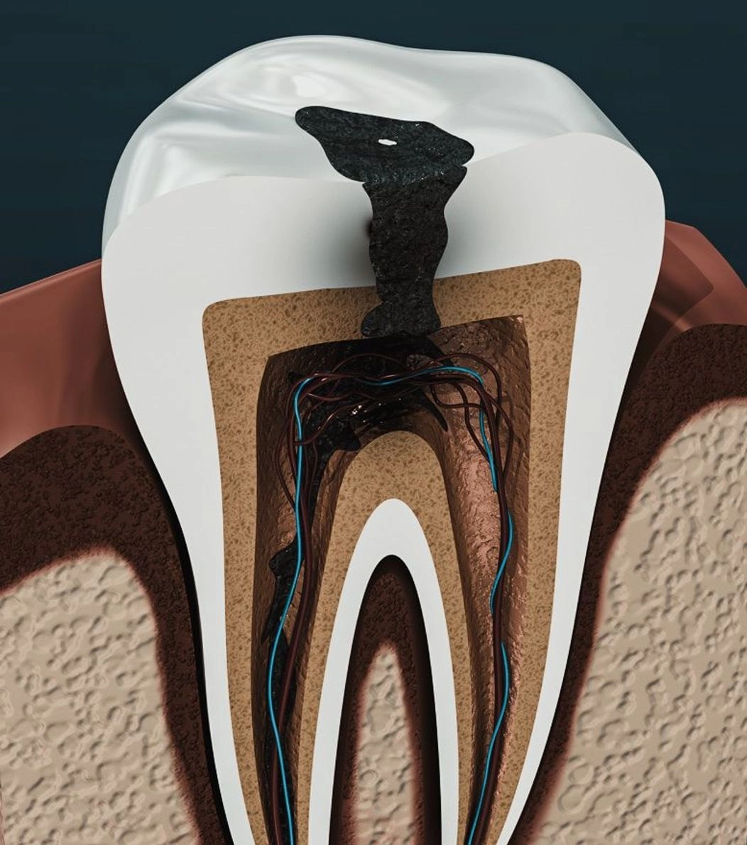 An image of the anatomy of a tooth showing an abscess on the tooth