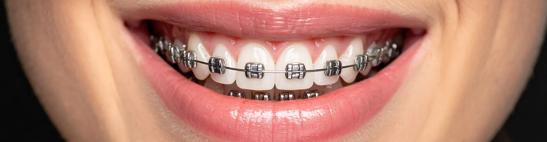 Woman's smile with metal braces.