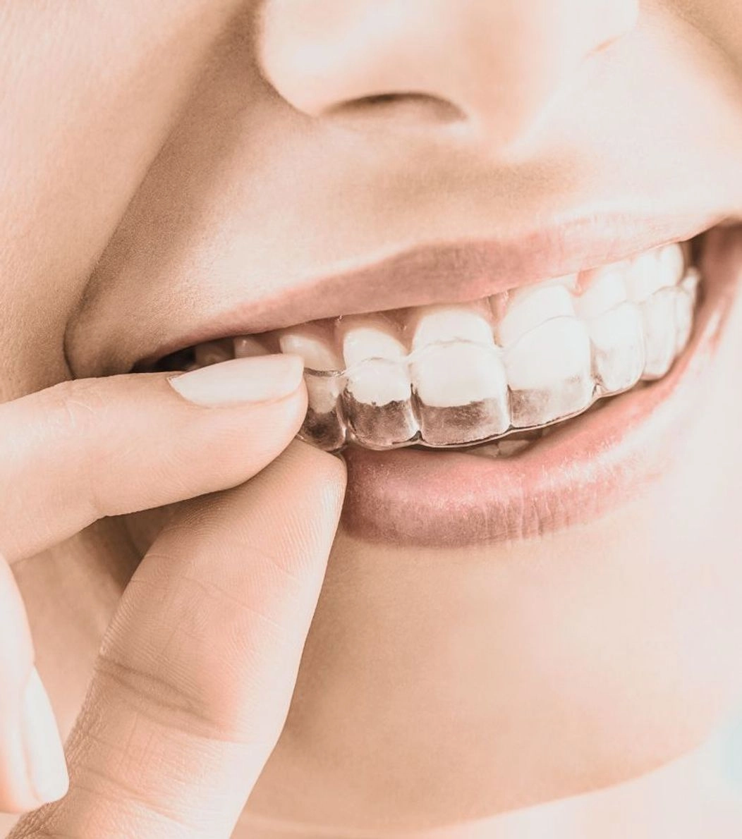 An image of the Invisalign aligners on the teeth