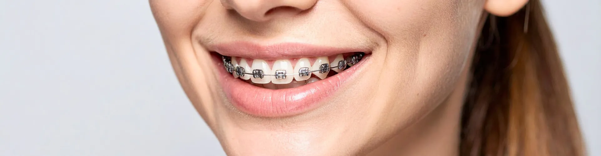 Girl's smile with braces.