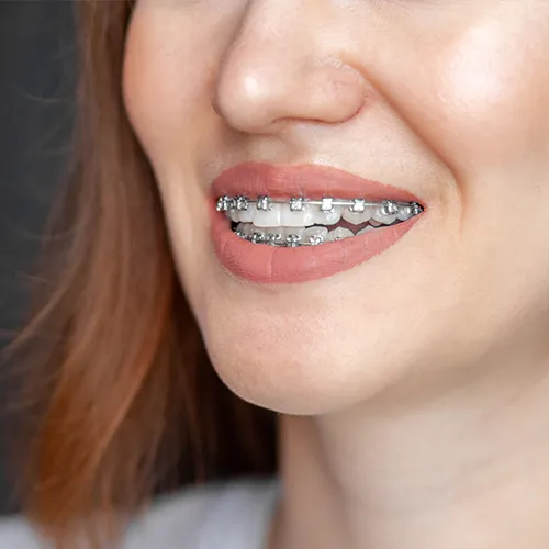 Woman's smile with braces.
