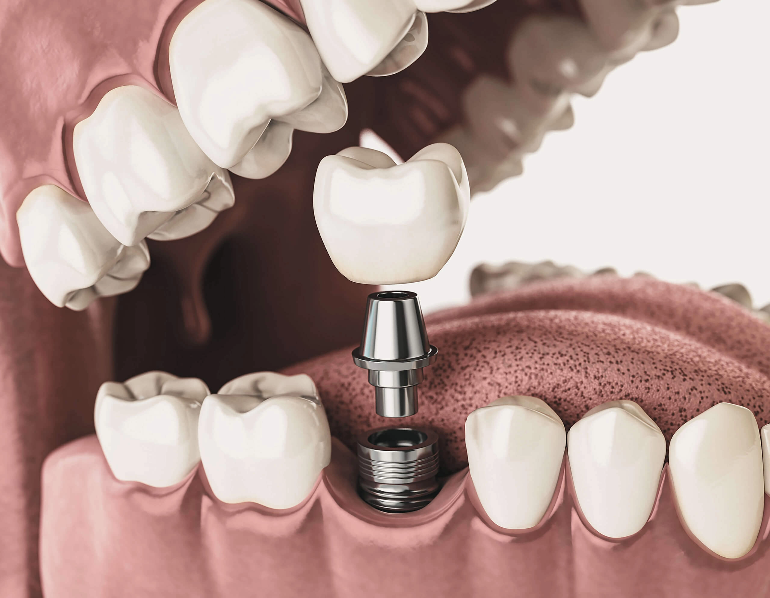 Image of a dental implant being placed