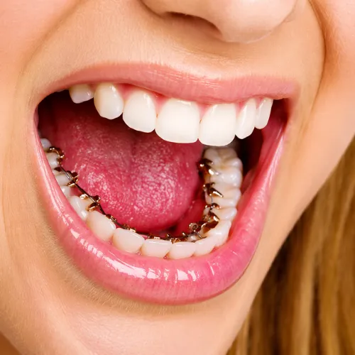 Woman opening her mouth to show braces on the back of her bottom teeth.