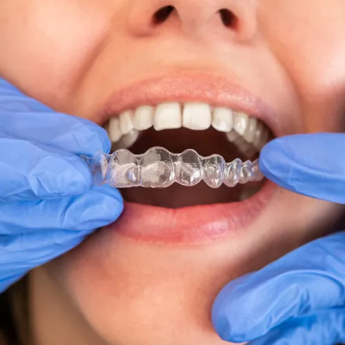 Close-up of clear Invisalign aligners being held in front of a patient's teeth by gloved hands.