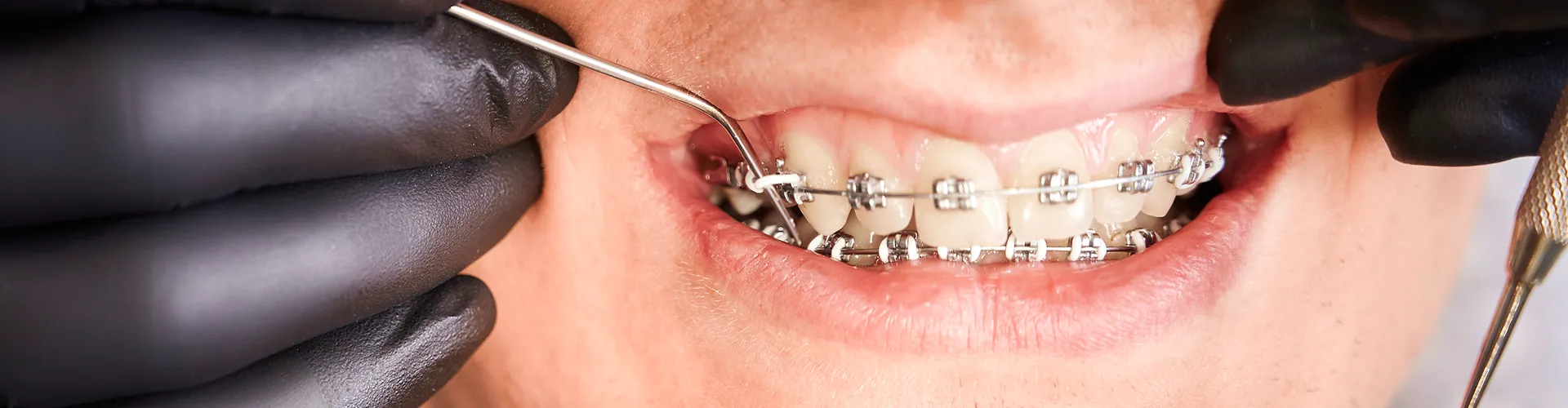 Gloved hands using dental tools on smile of boy with braces.