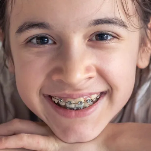 Smiling child wearing traditional metal braces, showing healthy teeth during orthodontic treatment.