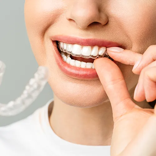 Woman placing clear aligner in her mouth.