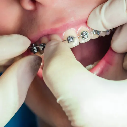 Orthodontist adjusting metal braces on patient teeth during a professional dental office appointment.