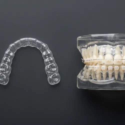 Clear aligner beside clear mouth model with ceramic braces.