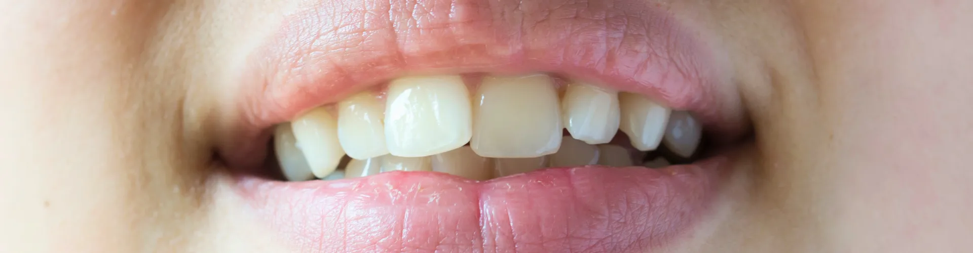 Woman's smile with crooked teeth.