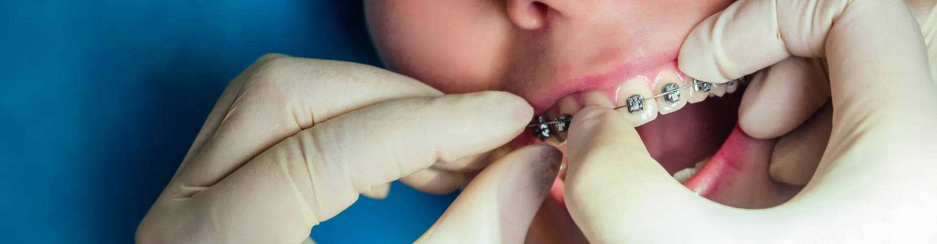 Orthodontist adjusting metal braces on patient teeth during a professional dental office appointment.