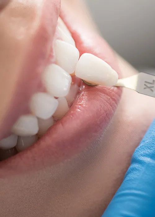 An image of dentist placing veneers on a lady's teeth